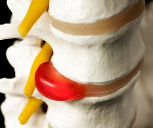 slipped disc